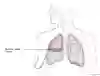 Thoraxdränage vid hemothorax i genomskärning där de olika delarna namnges samt dränageplacering.