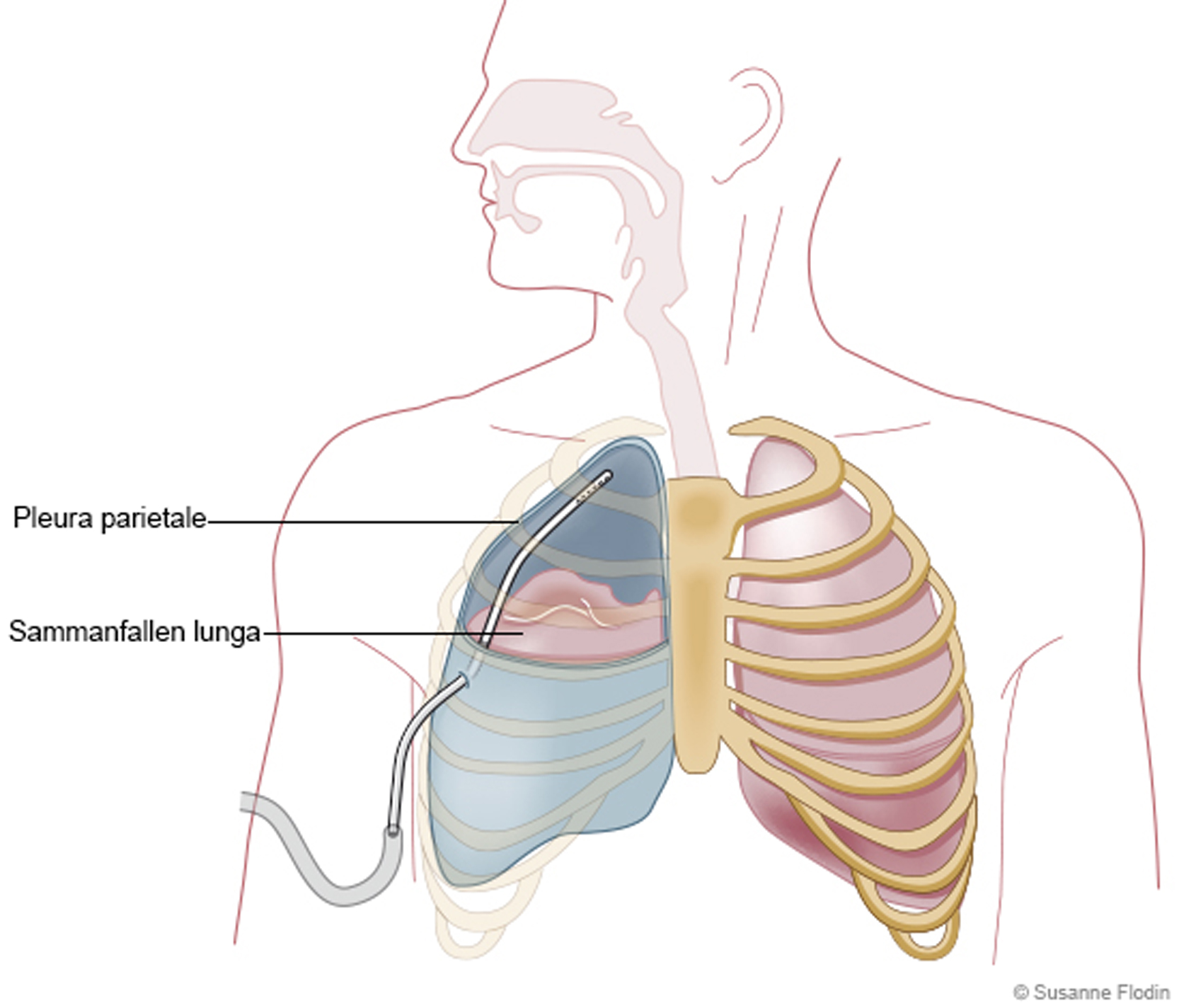 vatten i lungsäcken symptom vatten i lungsäcken symptom