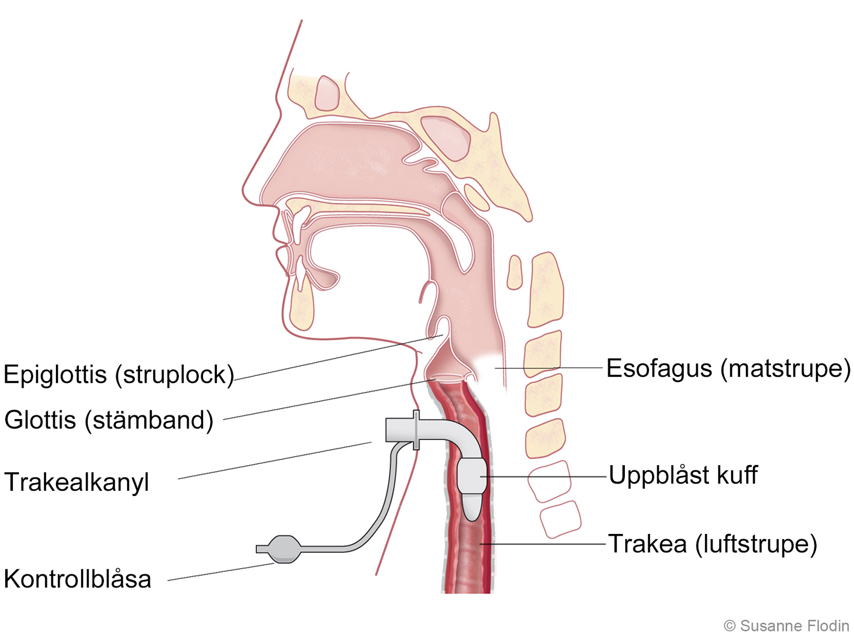 Anatomisk bild som visar trakeostomi