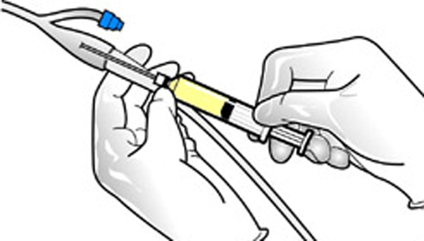 Bild som visar urinprovtagning ur kateter