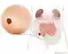 Anatomisk bild som visar urostomi