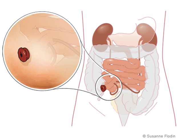 Anatomisk bild som visar urostomi